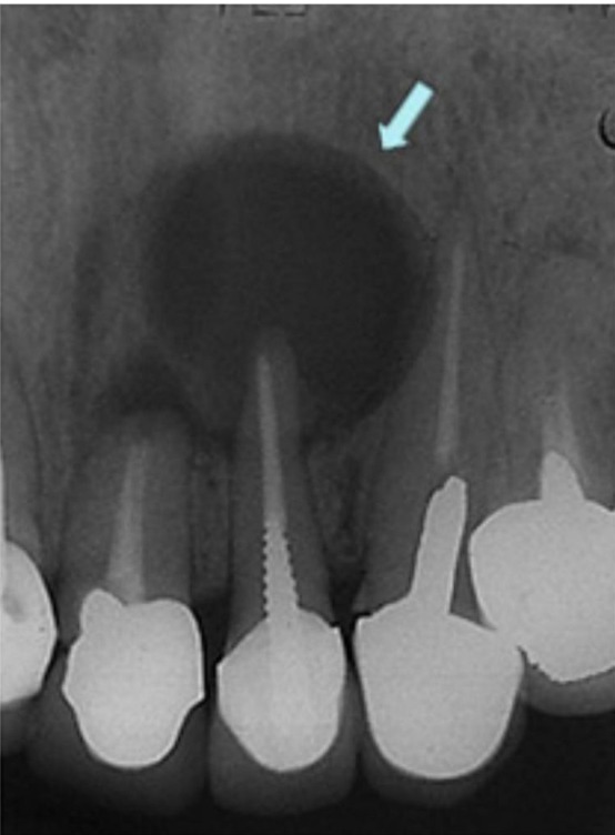 歯根 嚢胞 レントゲン に 映ら ない